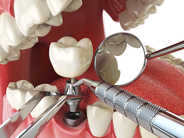 Best Emergency Dentist for Lost Fillings or Crowns in Irmo, SC