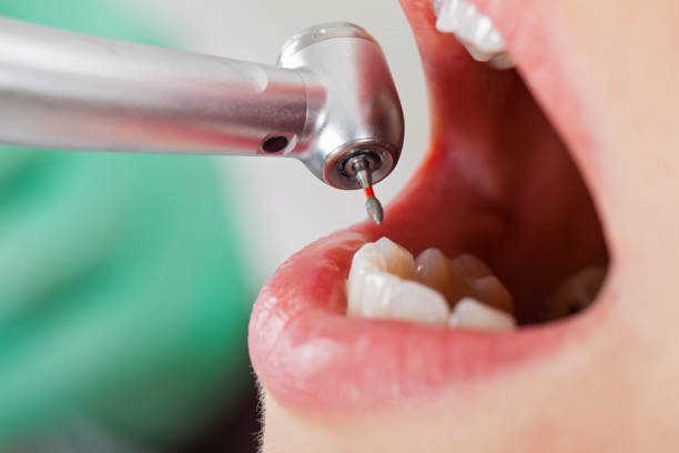 Best Emergency Dentist for Lost Fillings or Crowns in Irmo, SC